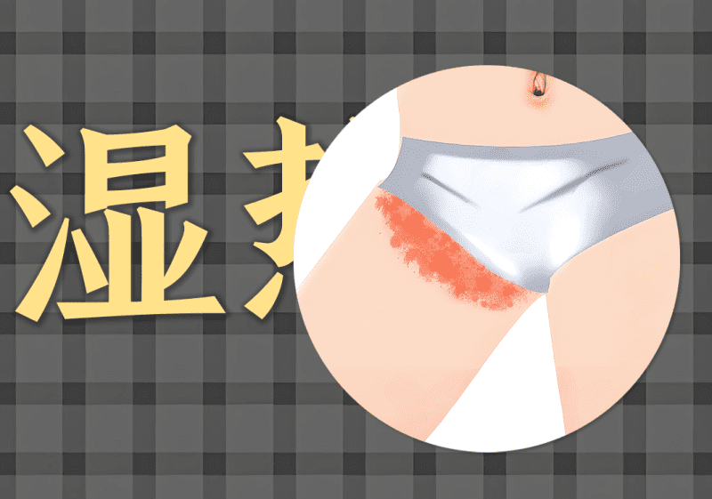 脐针:湿热下注偏头痛病例-善米