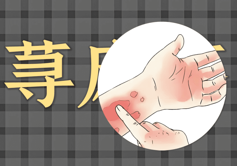 汤药:荨麻疹病例-善米